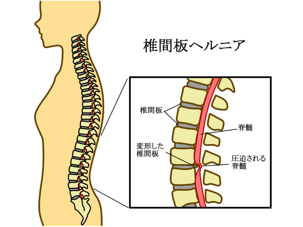 ヘルニア